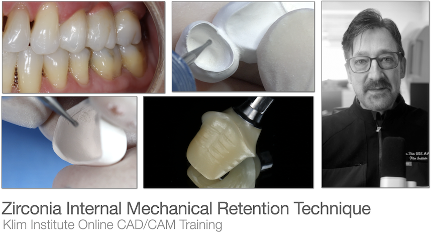 Zirconia cementation