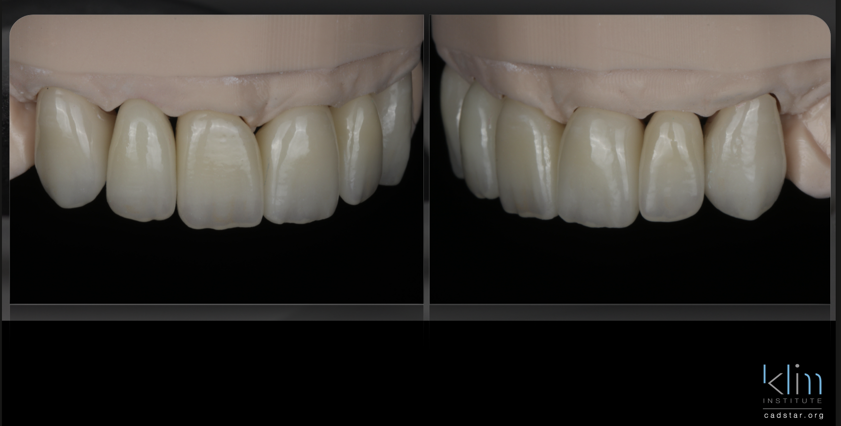 Anterior Zirconia