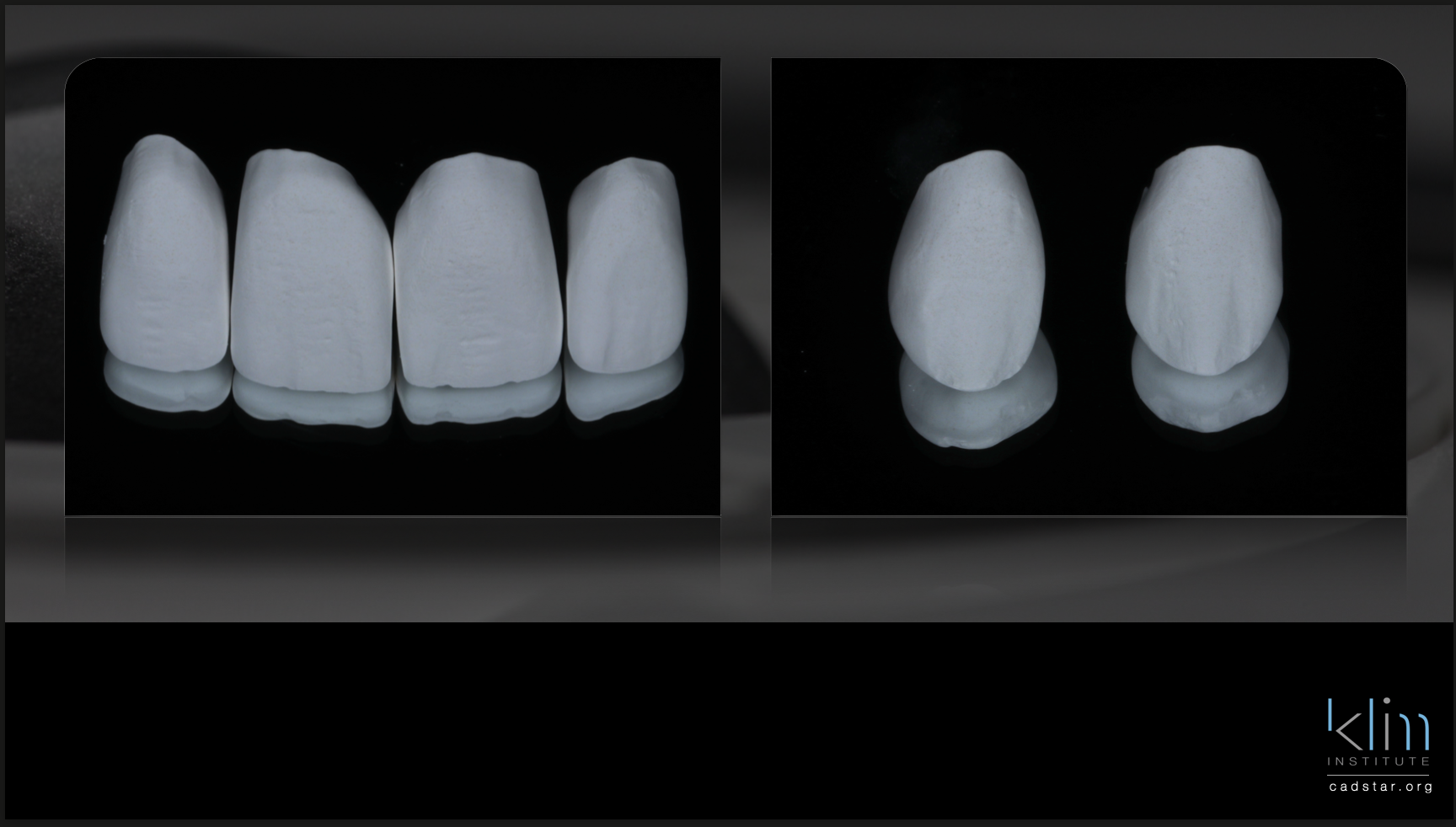 anterior Zirconia