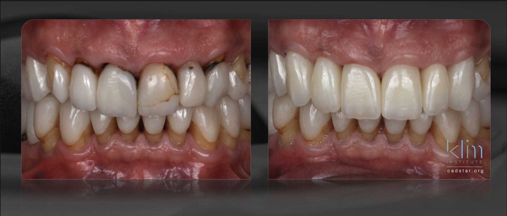 Anterior Zirconia