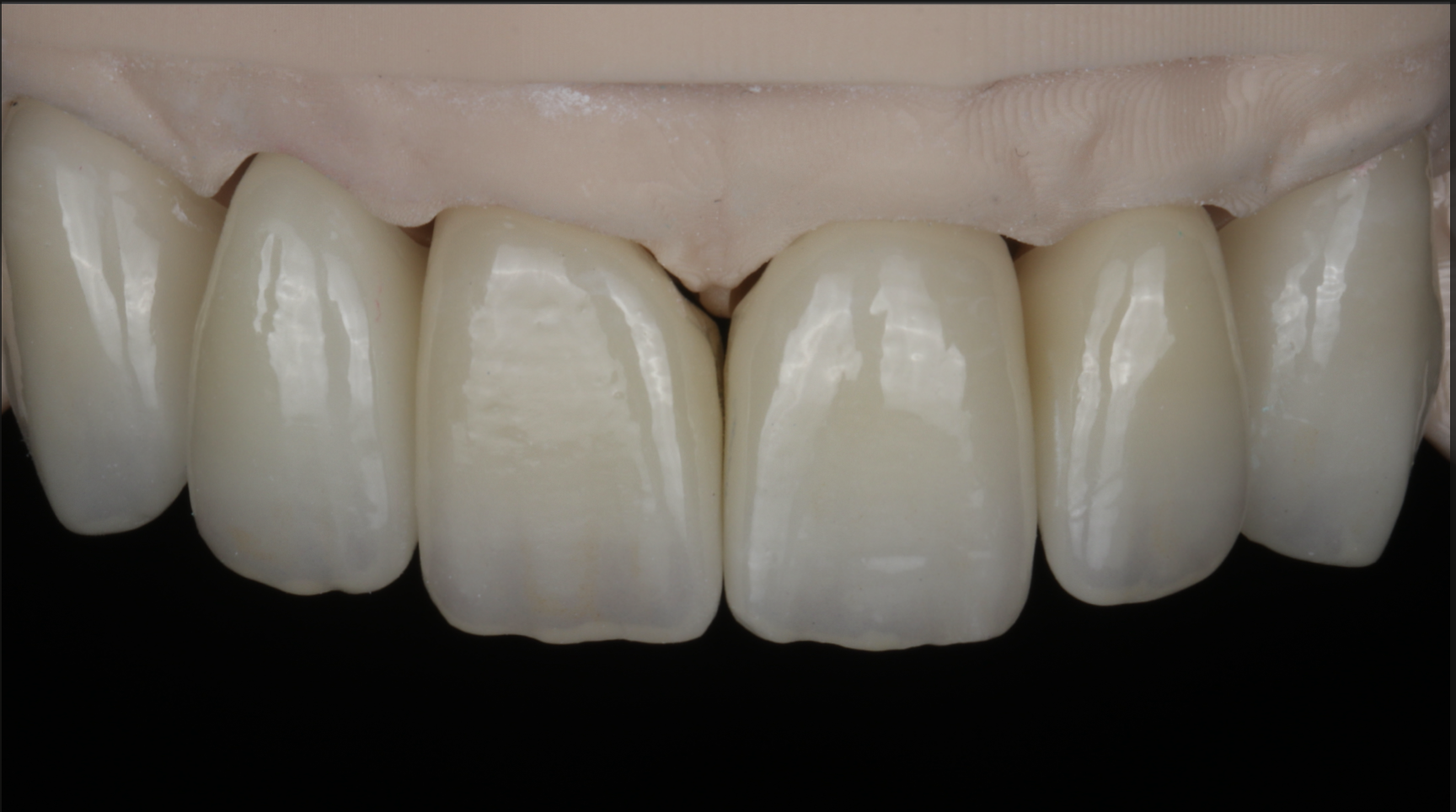 Anterior Zirconia