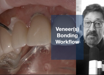 Veneer Bonding Workflow