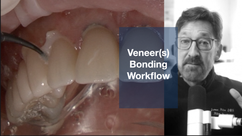 Veneer Bonding Workflow