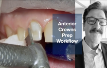 Anterior Crown Preparation Workflow